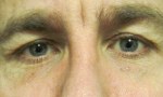 surgical blepharoplasty uppers 2a