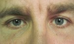 surgical blepharoplasty uppers 2b
