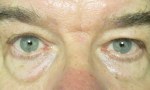 surgical blepharoplasty lowers fat transp 2a