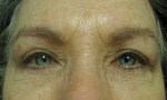 surgical blepharoplasty transcut lowers 1b