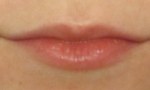 restylane lips 1a